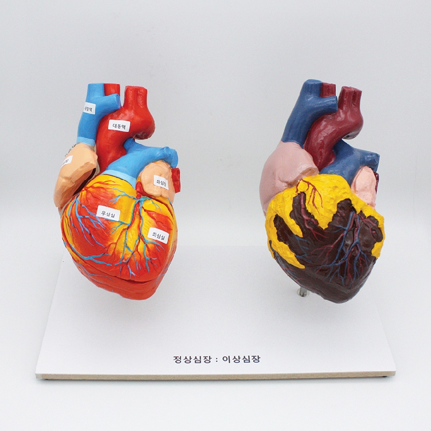 정상심장과 이상심장 비교 모형(심장의 구조기능)
