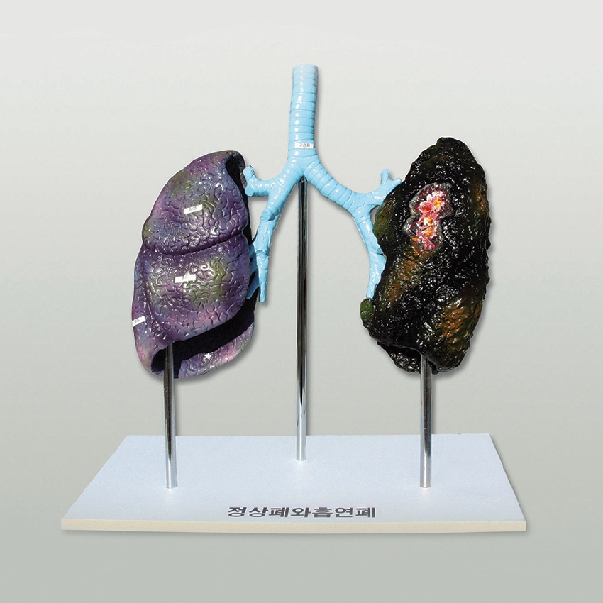 폐의 비교 모형(정상폐와 흡연폐)흡연의 영향